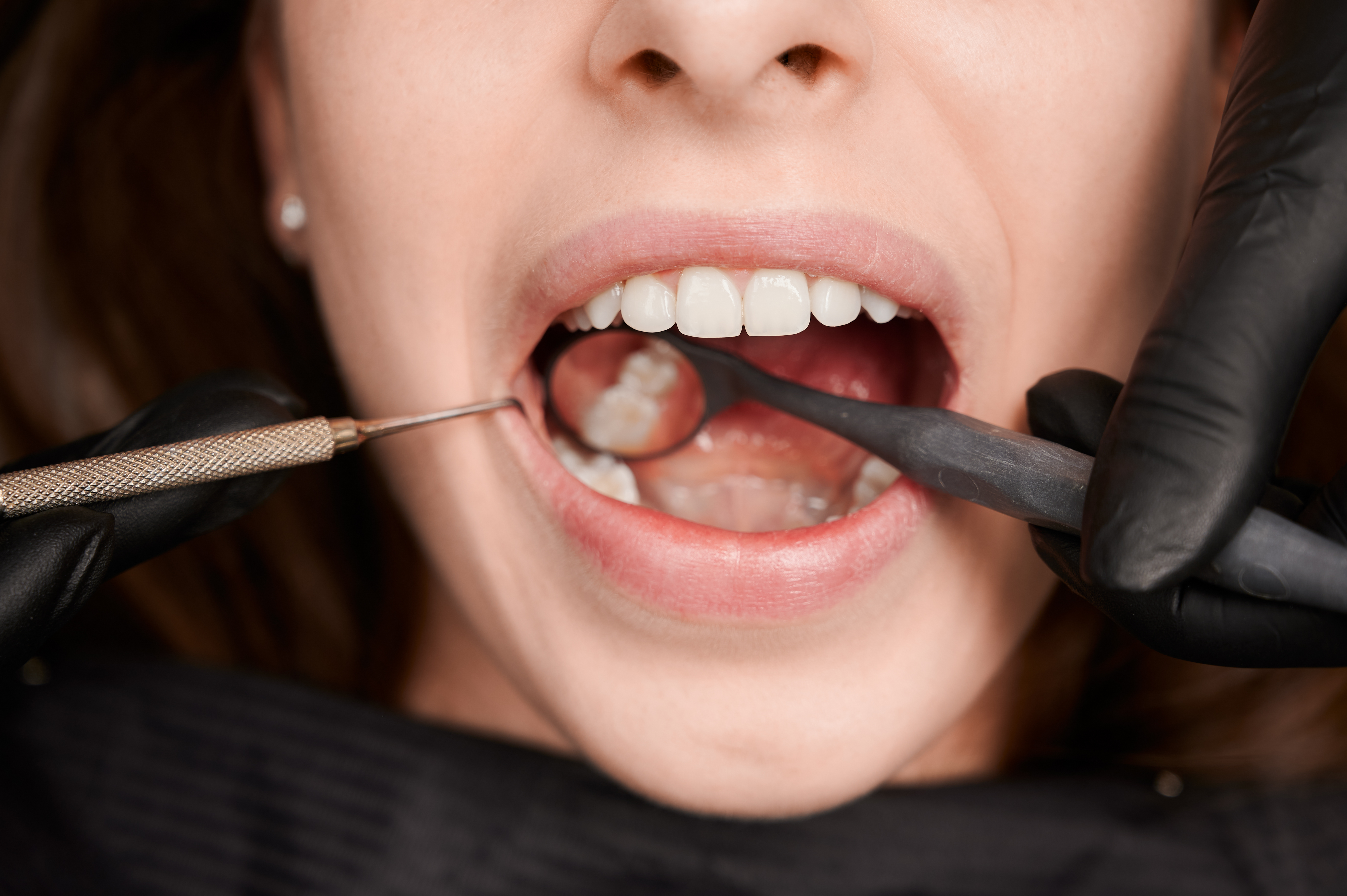 wisdom teeth removal in Ventura