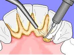 Tartar removal